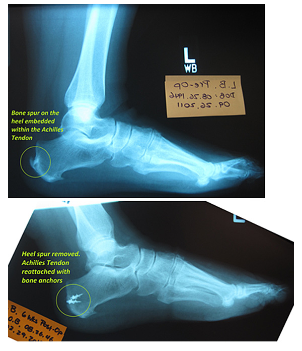 Surgery to remove bone spur and diseased portion of the Achilles Tendon.