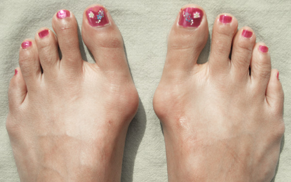 Bunions are hereditary. It occurs more often in females than males.