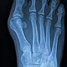 bunion-surgery-featured