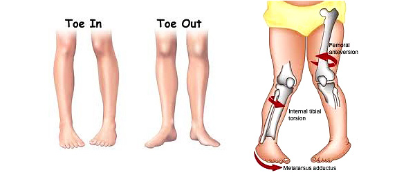 In-toeing gait can be caused by inward rotation of the hip or the leg.