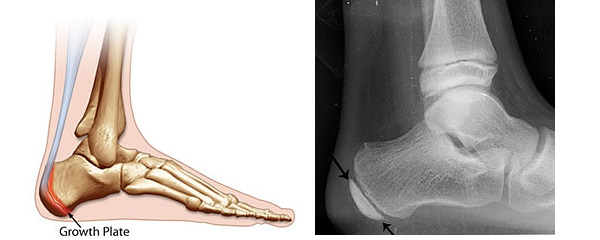 Heel pain in children, Sever's decease, is caused by inflammation of the growth plate.