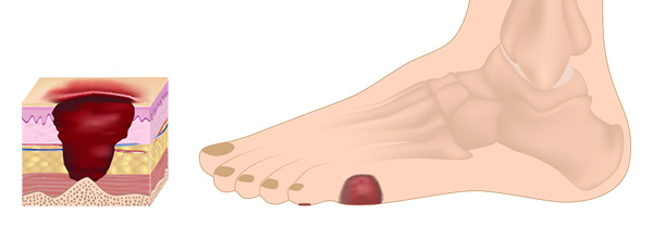 Diabetic ulcerations are common in patients with uncontrolled diabetes and showing symptoms of neuropathy.