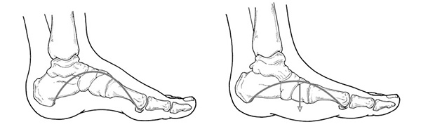 Normal foot alignment versus flatfoot.
