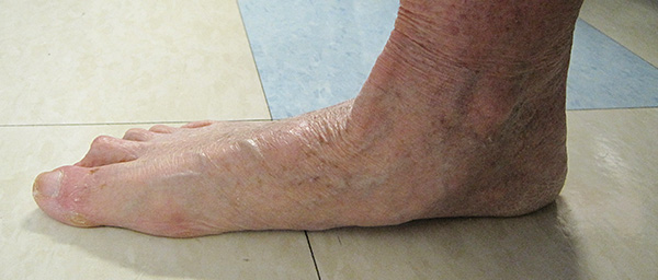 Example of moderate-severe long-standing Flatfoot Deformity (Adult Acquired Flatfoot).
