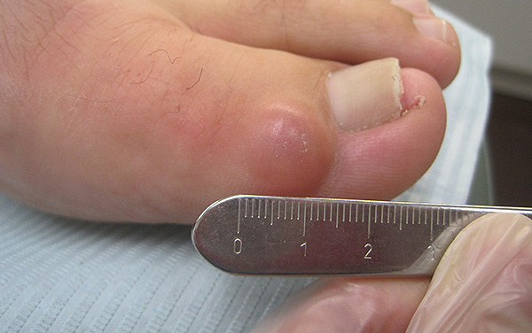 Ganglion Cyst on a big toe.