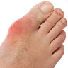 gout-featured