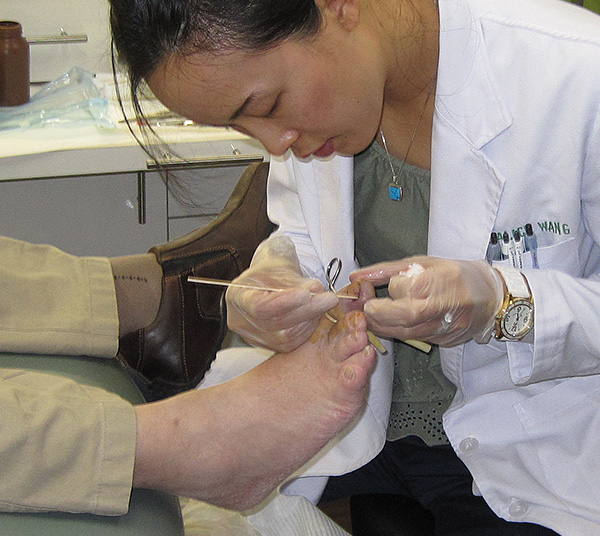 Dr. Alice Wang performing an ingrown toenail procedure.