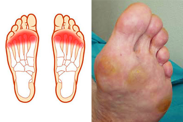 Painful calluses are often associated with metatarsalgia.