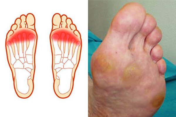 Metatarsalgia Causas Y Sintomas Kulturaupice