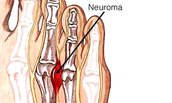 Neuroma - enlargement of metatarsal nerve due to chronic irritation.