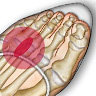 mortons-neuroma-featured