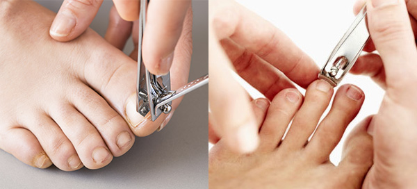 Trimming your nail straight across and avoid cutting them too short can prevent development of ingrown toenails.