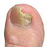 nail-fungus-featured