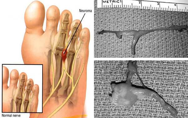 neuroma-surgery-dr-alice-wang