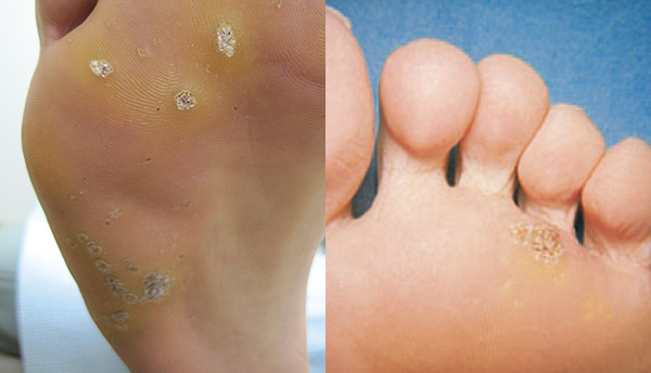 warts foot spreading