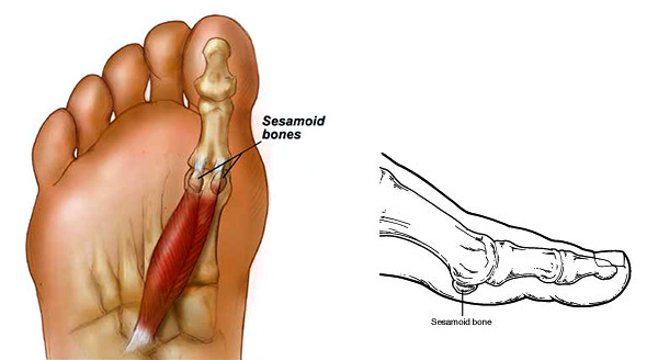 Sesamoids are two small bones under the big toe joint.
