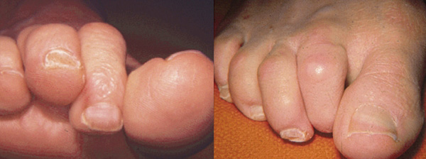 Hammertoe is a typical toe deformity.