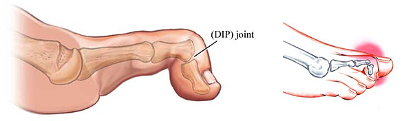 mallet toe surgery