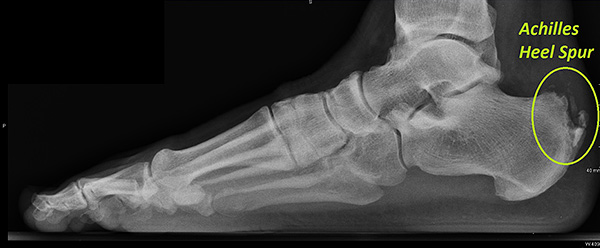 In chronic Achilles problem, calcium deposits can be found within the Achilles tendon where it attaches to the heel bone.