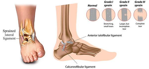 Ankle sprain can cause partial or complete tear of supporting ligaments.