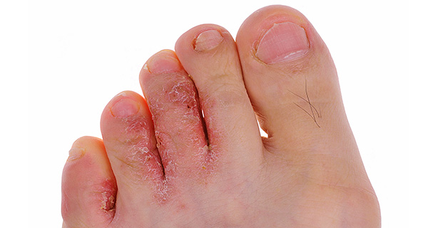 Athlete's foot can cause dry, itchy, cracked skin in between the toes.