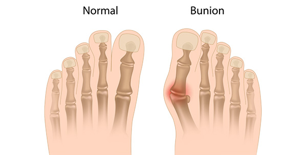 The big toe joint is malaligned in most bunion deformities.