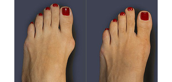 Before and after bunion surgery.