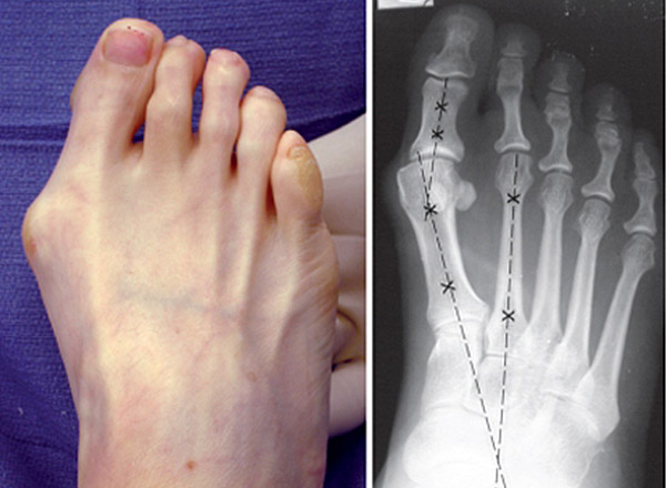 Some bunions are asymptomatic while others may experience pain over the 