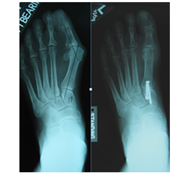 If pain persists despite conservative treatment, surgical correction of bunion can reduce pain significantly. Bunion surgery aims to re-align the big toe joint, improving its function.