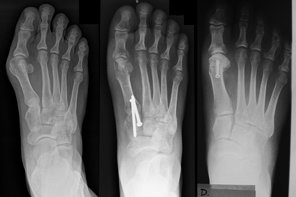 Before and after bunion surgery. Different types of bunion surgery is demonstrated.