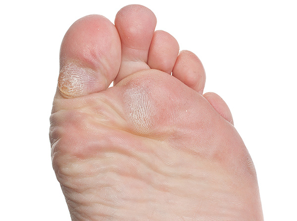 Can I Remove Minor Calluses From My Feet?