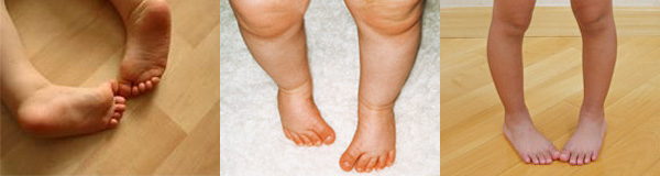 In-toeing gait is a common gait abnormality found in children.
