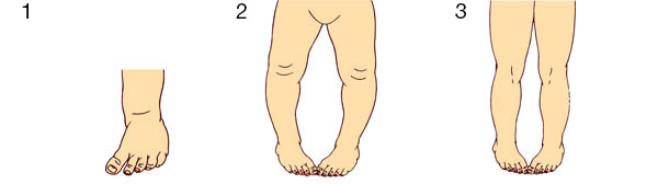 In-toeing gait conditions: matatarsus vanus (1), internal tibial torsion (2), and medial femoral torsion (3).