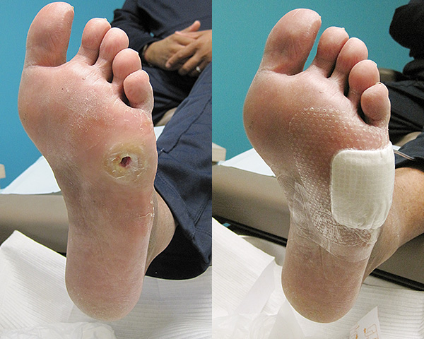 Ulceration in a diabetic patient with lack of sensation to his feet.