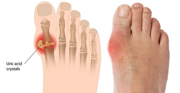 Uric acid crystals are deposited in the joint during an acute gout attack.  The big toe joint is commonly involved.