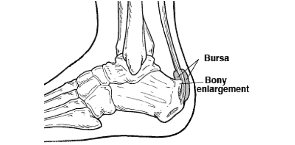 Bursa - represents soft tissue formation secondary to chronic irritation from Haglund's Deformity.