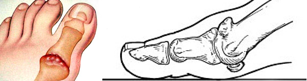 Hallux Rigidus is advanced arthritis within the big toe joint in which motion is very limited.