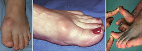 Hallux Limitus/Rigidus is caused by arthritic changes occurring at big toe joint, resulting diminished motion and function.