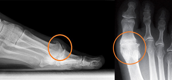 Bone spurs or overgrowths are often associated with arthritis in the big toe joint.