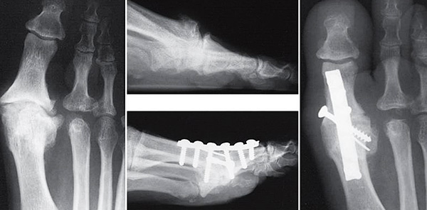 Surgical fusion of the big toe joint with severe arthritis.