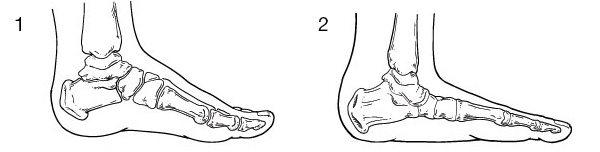 Comparing normal pediatric foot (1) and flatfoot (2).