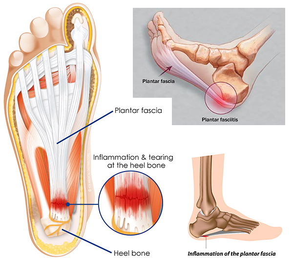 Plantar Fasciitis, inflammation of the plantar fascia is the most common cause of heel pain.