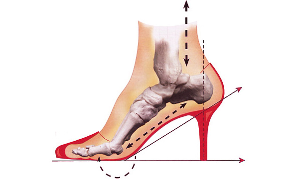 High heels or shoes that are too flexible can lead to injuries of the sesamoid due to increase pressure in this area.
