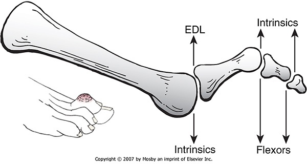 Hammertoe is caused by imbalance between intrinsic and extrinsic muscle of the foot.
